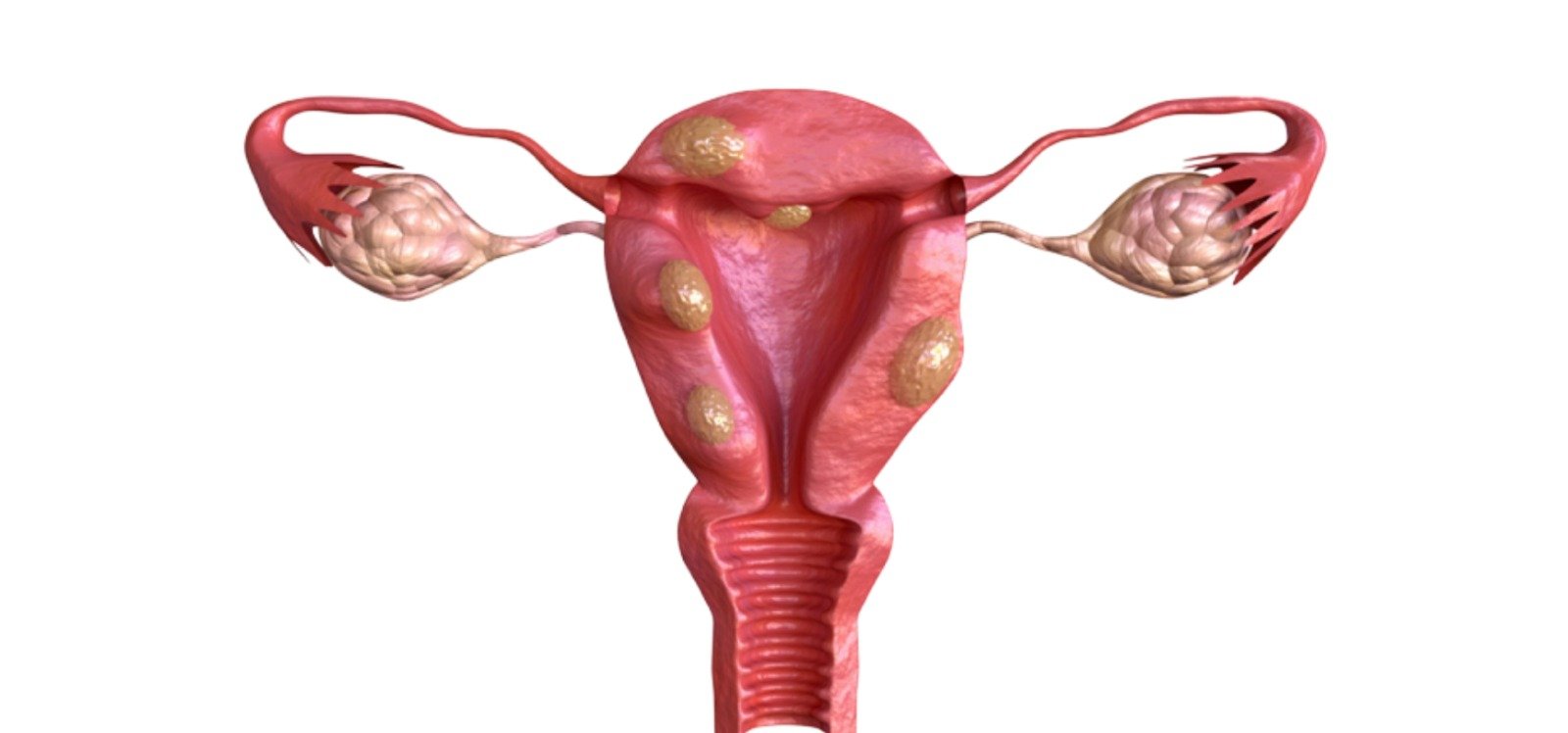 Fibroids treatment by dr avani reddy