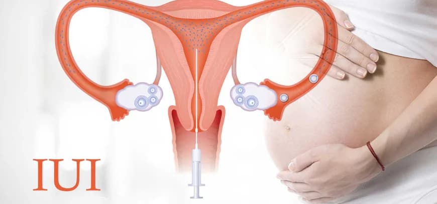 IUI